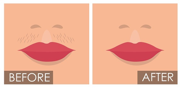 Before and after upper lip laser hair removal at Goenka Spine and Skin Centre – Best Spine & Skin Clinic in Raipur