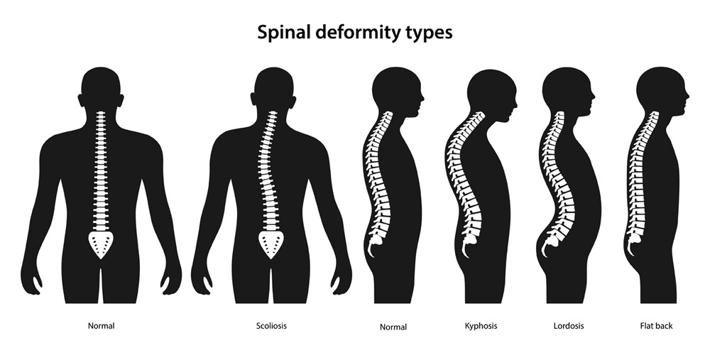 Spinal deformity treatment at Goenka Spine and Skin Centre – Best Spine & Skin Clinic in Raipur