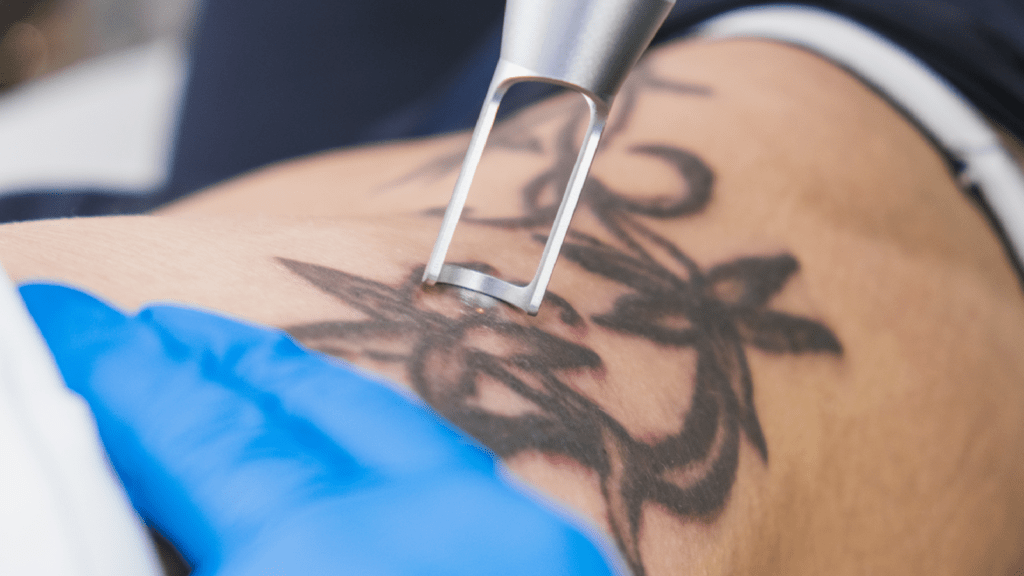 Laser tattoo removal treatment in progress at Goenka Spine and Skin Centre – Best Spine & Skin Clinic in Raipur