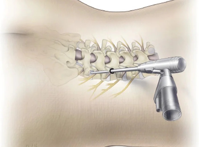 Minimally invasive spine surgery procedure at Goenka Spine and Skin Centre – Best Spine & Skin Clinic in Raipur