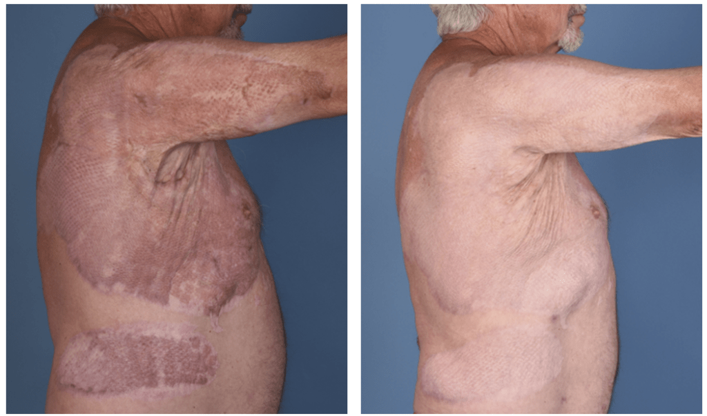 Burn scar treatment before and after results at Goenka Spine and Skin Centre, Best Spine & Skin Clinic in Raipur