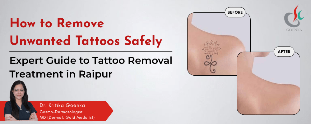 How to Remove Unwanted Tattoos Safely: Expert Guide to Tattoo Removal Treatment in Raipur